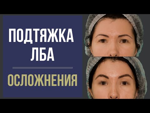 Видео: ЭНДОСКОПИЧЕСКАЯ ПОДТЯЖКА ЛБА И БРОВЕЙ 😯 ОСЛОЖНЕНИЯ ⛔