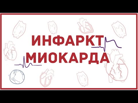 Видео: Инфаркт миокарда - обзорно - причины, патофизиология, симптомы, ЭКГ