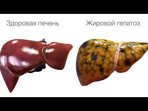 Видео: Лучшие Упражнения Для ПЕЧЕНИ