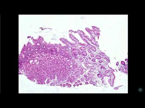 Видео: Атрофия в желудке. Что же мы о ней знаем?