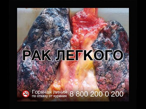 Видео: 02-10 Опухоли легких