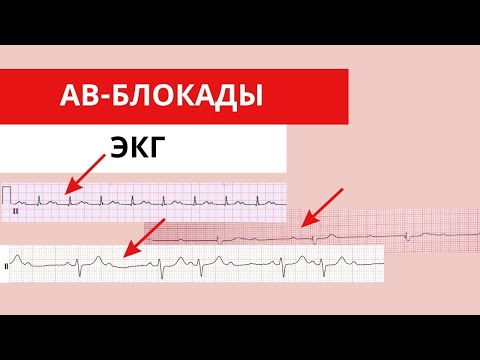 Видео: АВ-блокады. ЭКГ диагностика. Клинические примеры. Атриовентрикулярные блокады.