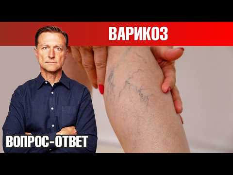 Видео: Как избавиться от варикоза 👉 лучший способ и профилактика