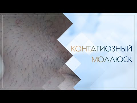 Видео: 😐 Контагиозный моллюск