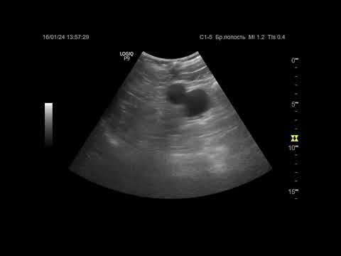 Видео: УЗИ. Доктор Иогансен. Видеопримеры. Выпуск 115. Кисты почек (5).