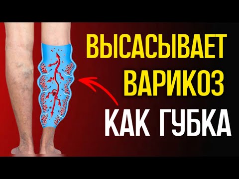 Видео: Оказывается, варикоз реально лечится! Простые средства есть у каждого дома!