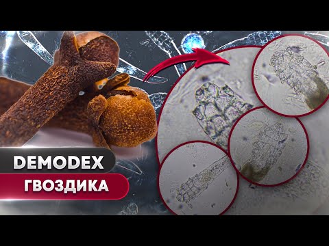 Видео: Гвоздика против демодекса - Убьёт ли специя клещей?