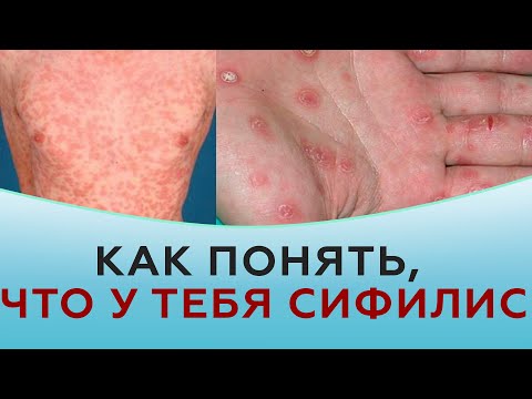 Видео: Как понять, что у тебя сифилис