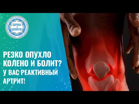 Видео: ⚡ РЕАКТИВНЫЙ АРТРИТ. Что это? Причины и лечение