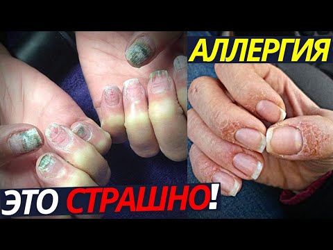 Видео: ЭТО СТРАШНО! Аллергия на ногтях | Маникюр и гель лак