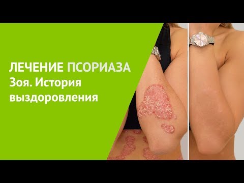 Видео: Лечение псориаза. Зоя, история выздоровления.
