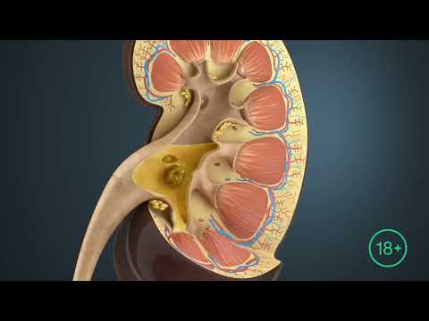 Видео: Сийдик тош касаллиги хақида тўлиқ маълумот олинг!!!