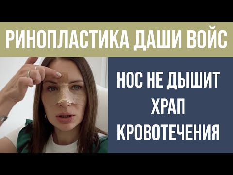 Видео: РИНОПЛАСТИКА У DASHA VOICE ⚡ НЕ ДЫШИТ НОС ⚡ ВСЕ СТАДИИ ШОКА