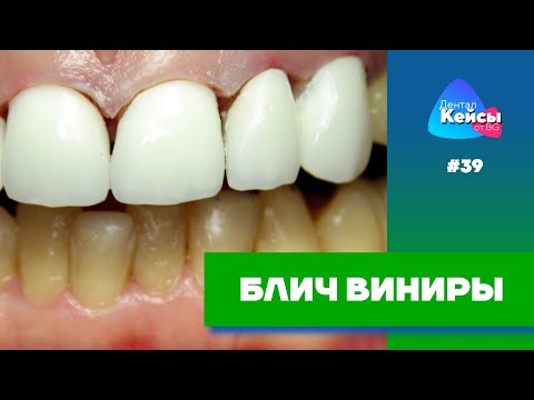 Видео: Блич виниры | Дентал Кейсы от BG #39