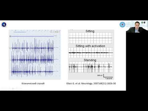 Видео: Красаков И.В. Ортостатический тремор, ортостатический миоклонус