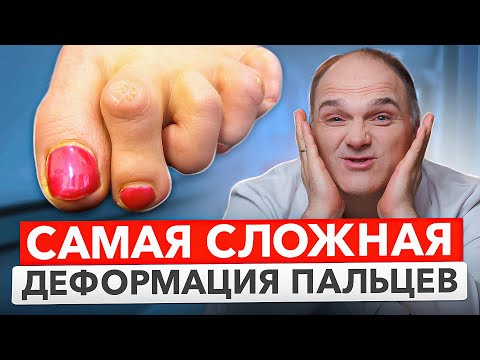 Видео: Молоткообразная и когтеобразная деформация пальцев стопы. Как лечить?