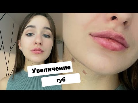 Видео: УВЕЛИЧЕНИЕ ГУБ / мой опыт с ФОТО / ВСЯ ПРАВДА И ПОСЛЕДСТВИЯ!