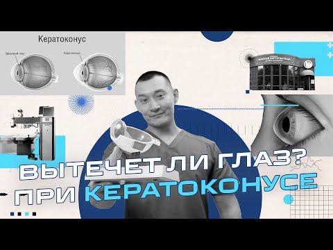 Видео: Кератоконус - Его нельзя вылечить, но можно замедлить.