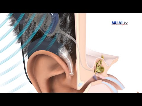 Видео: Кохлеарните импланти