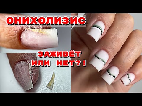Видео: ОНИХОЛИЗИС У МАМЫ Ч2 😱 Заживет или нет? 💅 Маникюр