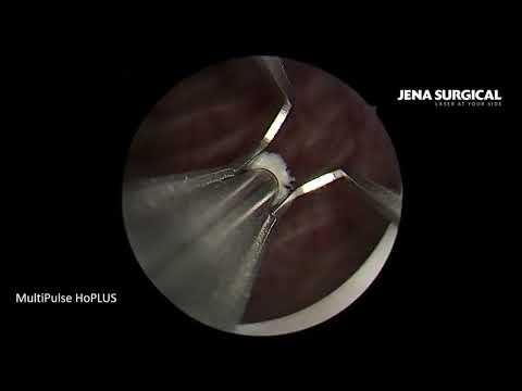 Видео: Лазерная инцизия шейки мочевого пузыря. Гольмиевый лазер MultiPulse HoPLUS .