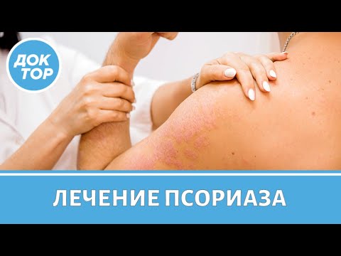 Видео: Причина и лечение псориаза