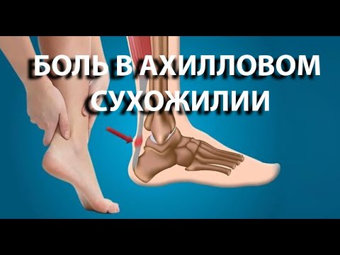 Видео: Что делать с болью в ахилловом сухожилии? Спасаем мир с доктором Демченко. Лечение беговых травм.