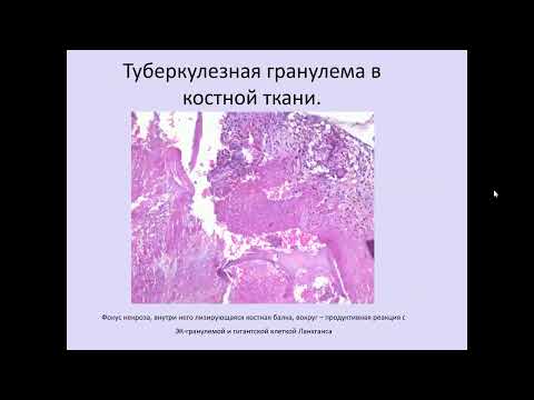 Видео: Основные характеристики внелегочных локализаций туберкулеза. Костно-суставной туберкулез.