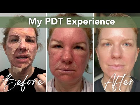 Видео: Фотодинамическая терапия (ФДТ) | Профилактика рака кожи и лечение актинического кератоза