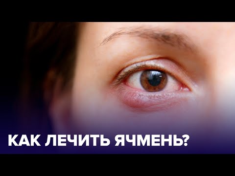 Видео: ЯЧМЕНЬ на глазу: как быстро ВЫЛЕЧИТЬ