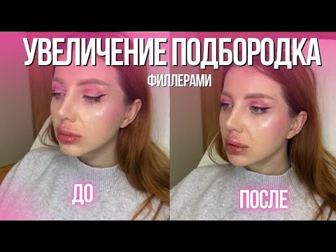 Видео: УВЕЛИЧИЛА ПОДБОРОК ФИЛЛЕРАМИ. ДО И ПОСЛЕ, РЕАБЕЛИТАЦИЯ. КОНТУРНАЯ ПЛАСТИКА ГУБ И ЛИЦА
