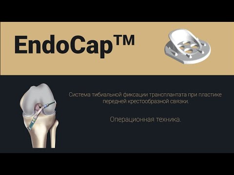 Видео: Система тибиальной фиксации трансплантата при пластике передней крестообразной связки EndoCap