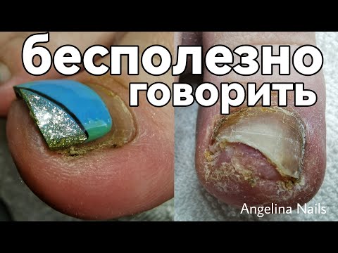 Видео: ТРАВМА ногтя / зачистка онихолизиса / гематома на пальце / сложный педикюр на перехоженным покрытием