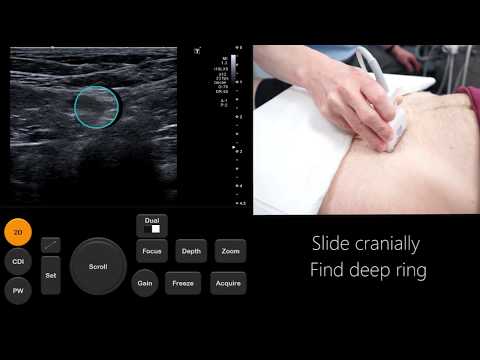 Видео: Учебное пособие по УЗИ: оценка паховой/бедренной грыжи | Radiology Nation