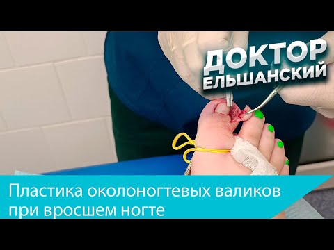 Видео: Вросший ноготь, пластика околоногтевых валиков обоих первых пальцев