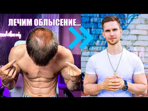 Видео: МУЖСКОЕ ОБЛЫСЕНИЕ! ЧТО ДЕЛАТЬ ПРИ ВЫПАДЕНИИ ВОЛОС, ЕСЛИ НЕТ ДЕНЕГ НА ПЕРЕСАДКУ?