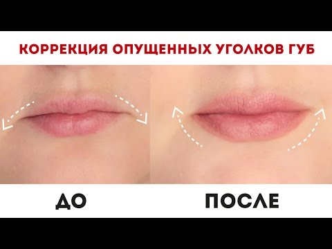 Видео: Коррекция опущенных уголков губ / Как приподнять уголки рта? / Диана Суворова