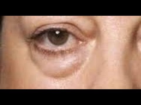 Видео: Аптечные средства ОТ МЕШКОВ ПОД ГЛАЗАМИ.