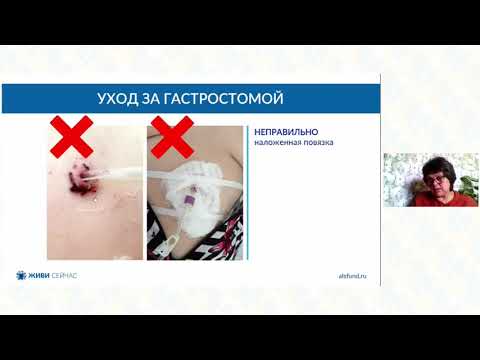 Видео: Уход за зондом и гастростомой.  Технологии и акценты.  Борисенко Л. Г.