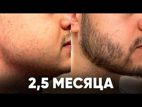 Видео: Отрастил НЕРЕАЛЬНУЮ бороду с нуля за 2,5 месяца. Результаты XINOXIN