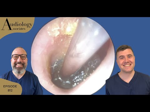 Видео: КОМПЛЕКТ ДЛЯ УДАЛЕНИЯ УШНОЙ СЕРЫ, ВКЛЮЧАЯ ОЧЕНЬ ГЛУБОКОЕ ПОПАДАНИЕ УШНОЙ СЕРЫ - EP812