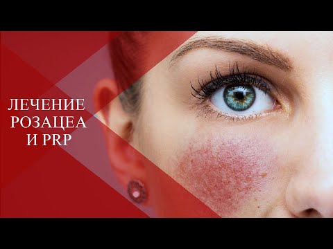 Видео: 💉РОЗАЦЕА  и КУПЕРОЗ | Преимущества Плазмотерапии при сосудистой форме розацеа I стадии