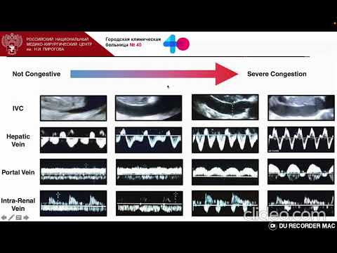 Видео: VExUS   ультразвуковой мониторинг венозного спланхнического кровотока