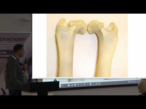 Видео: Остеоартрит как лечить