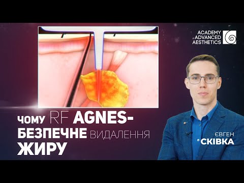 Видео: Чому RF AGNES це безпечне видалення жиру