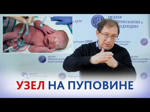 Видео: УЗЕЛ на ПУПОВИНЕ и преэклампсия. Чего ждать от следующей беременности?