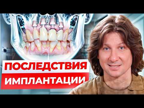 Видео: ВСЯ ПРАВДА про зубные импланты! / Главные ПРОТИВОПОКАЗАНИЯ к имплантации зубов