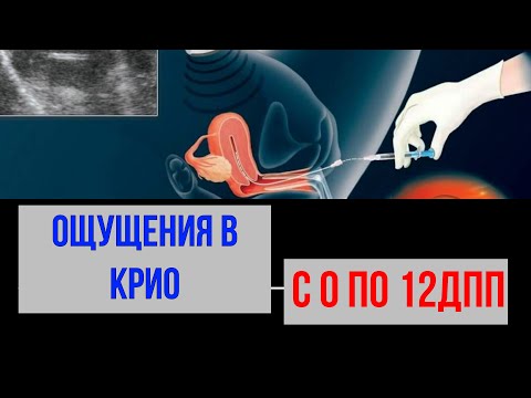 Видео: ЭКО. ОЩУЩЕНИЯ В КРИО С 0 по 12ДПП.Часть 2.Видео №12