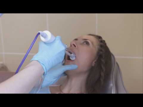 Видео: Лечение хронического тонзиллита