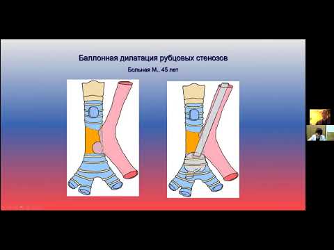 Видео: 3 Русаков М.А.  Рубцовые стенозы трахеи